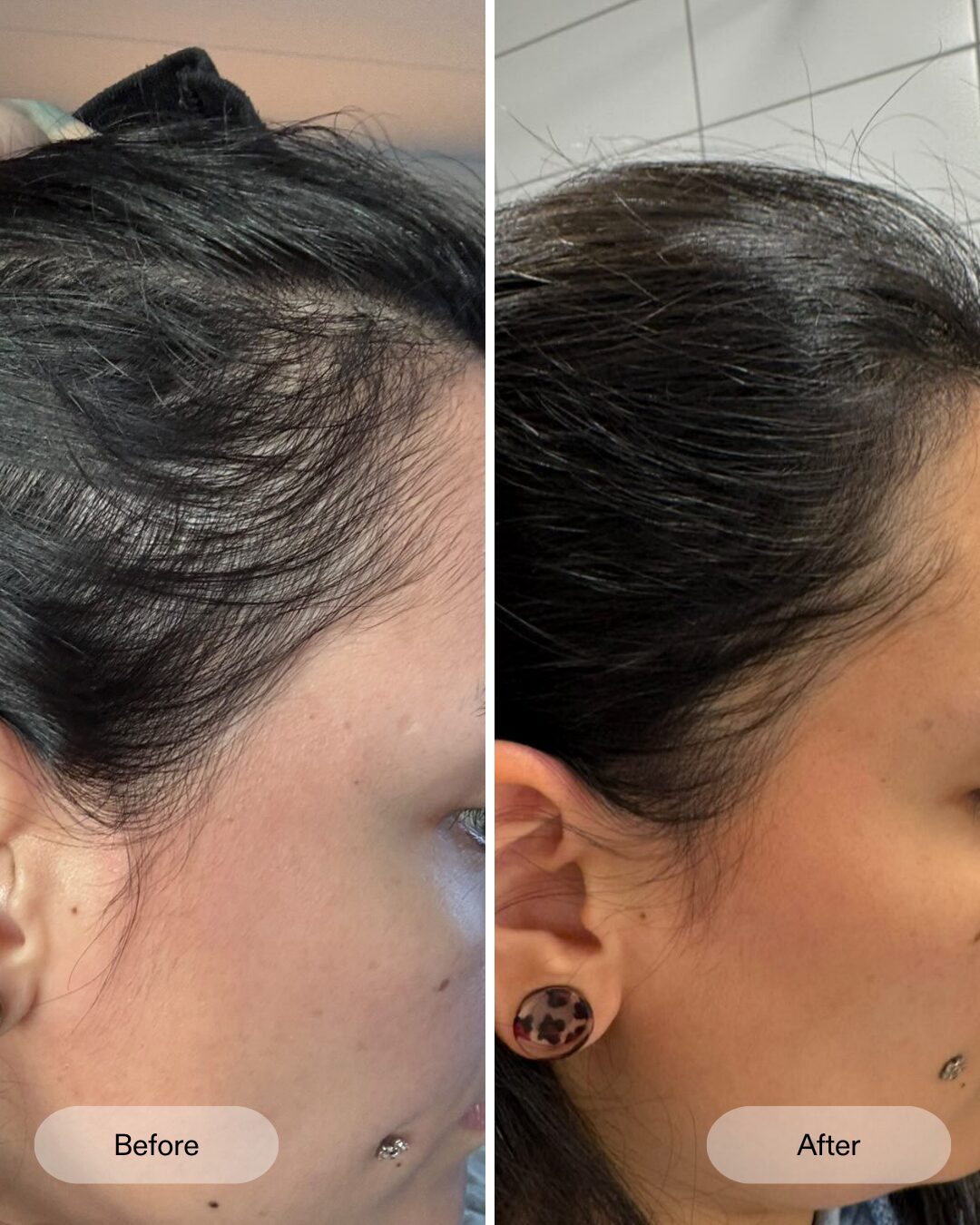 CurrentBody LED Helm Haarwachstum Ergebnis nach 12 Wochen